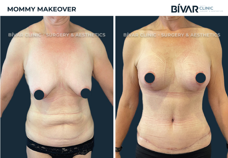 Mommy Makeover Lisboa