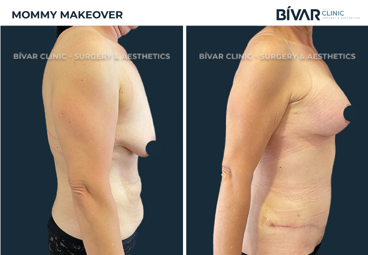 Mommy Makeover Lisboa
