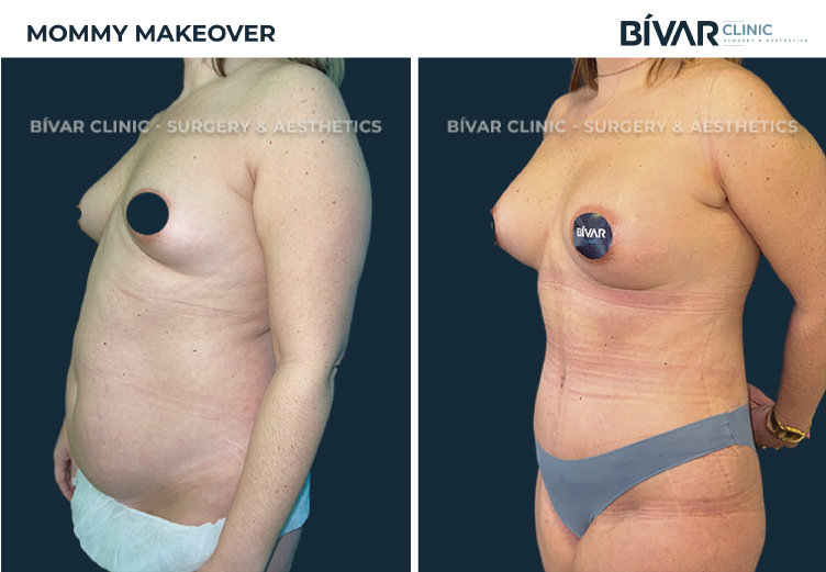 Mommy Makeover Lisboa