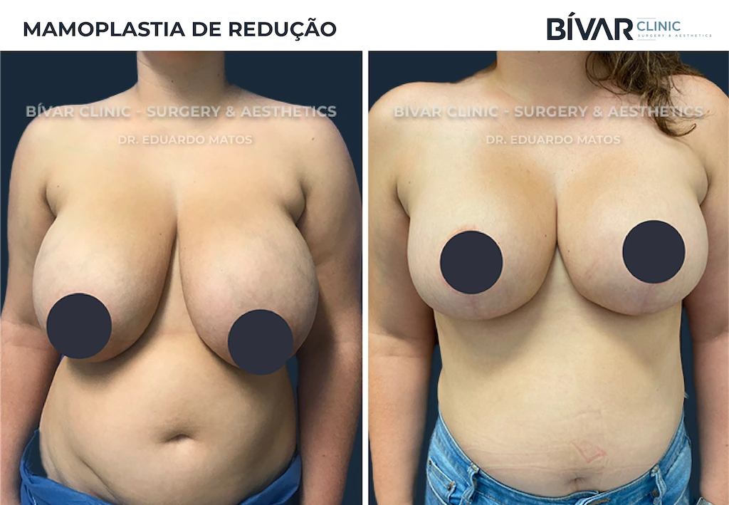 mamoplastiaderedução