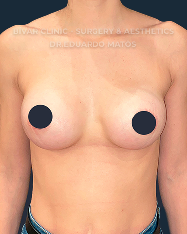 mamoplastia-de-aumento1