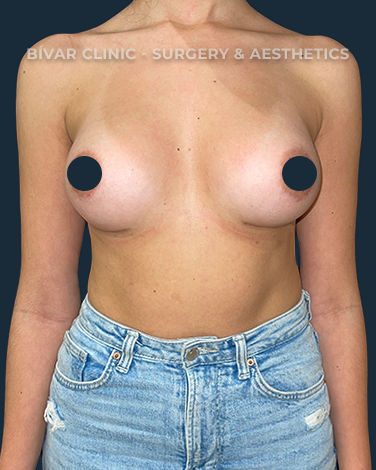 mamoplastia-de-aumento2