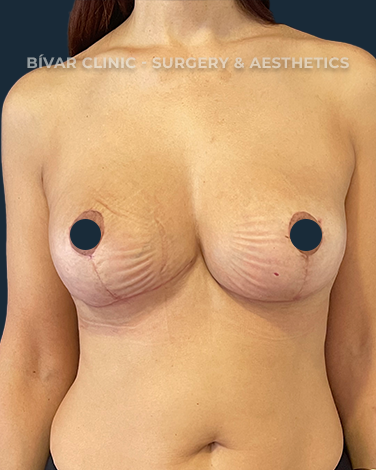 mastopexia-sem-implantes1