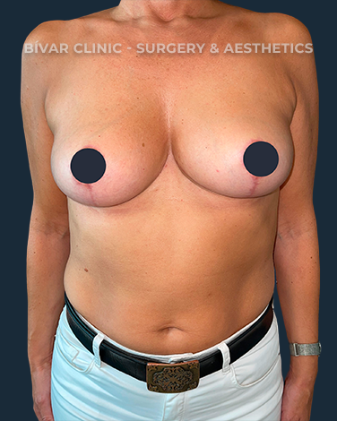 mastopexia-sem-implantes2