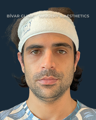 otoplastia1