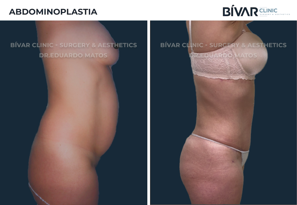 abdominoplastia
