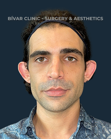 otoplastia em lisboa