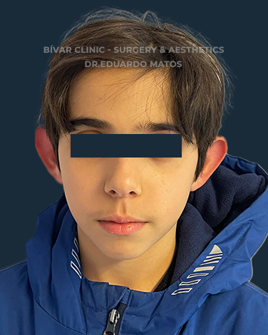 otoplastia