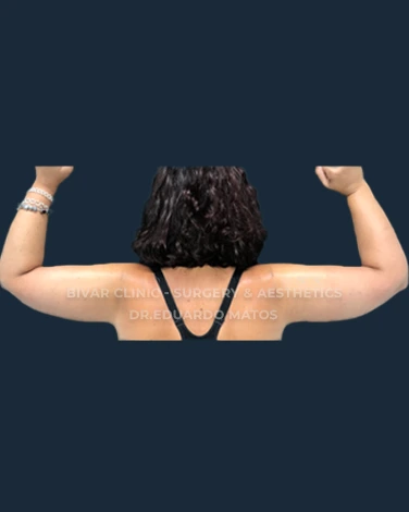 braquiplastia
