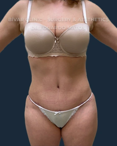 abdominoplastia
