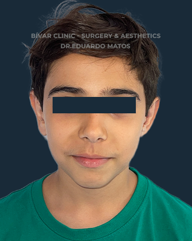 otoplastia