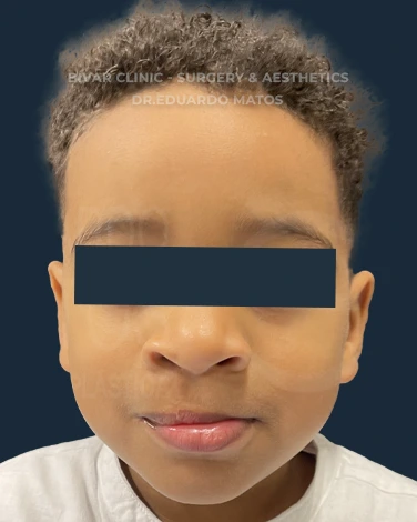 Fenda Labial
