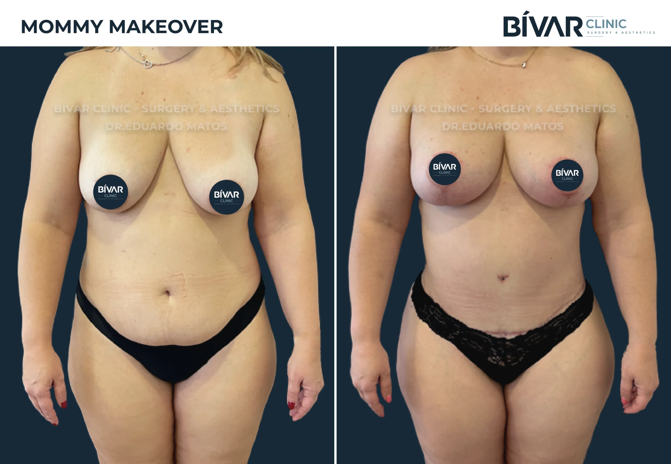 Mommy Makeover Lisboa