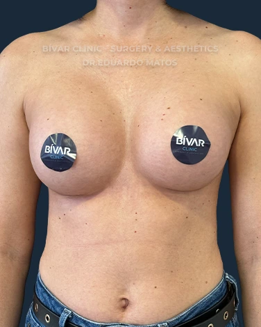 mamoplastia de aumento