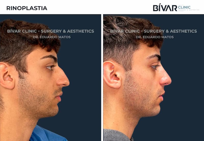 rinoplastia antes depois