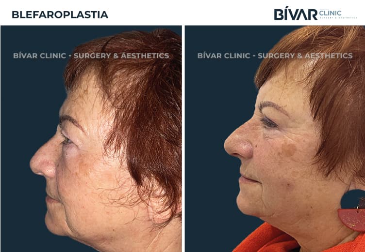blefaroplastia em lisboa