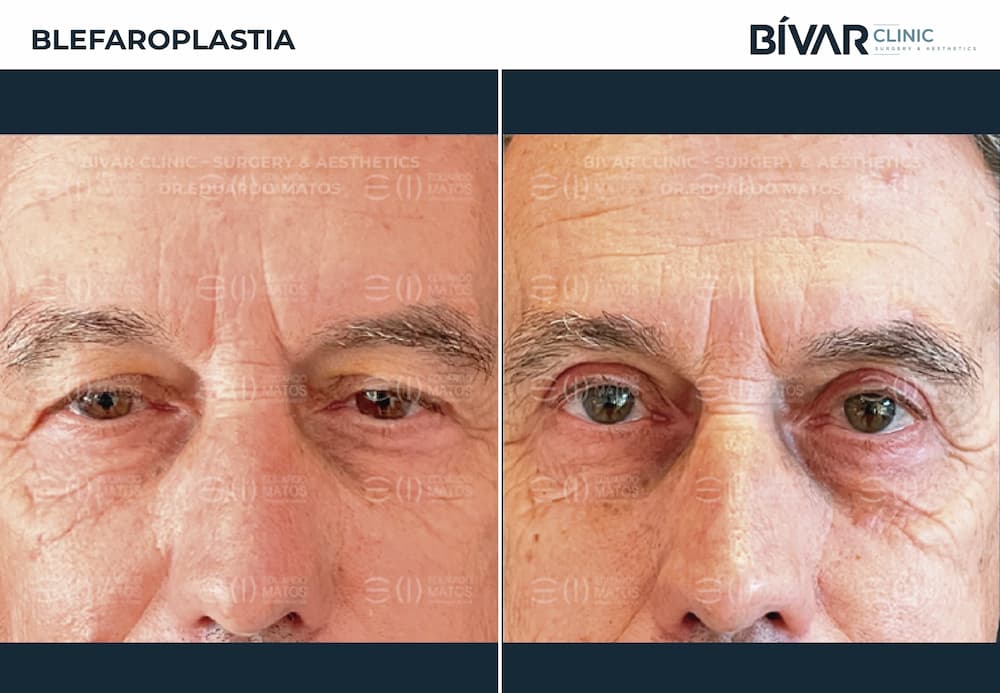 blefaroplastia lisboa