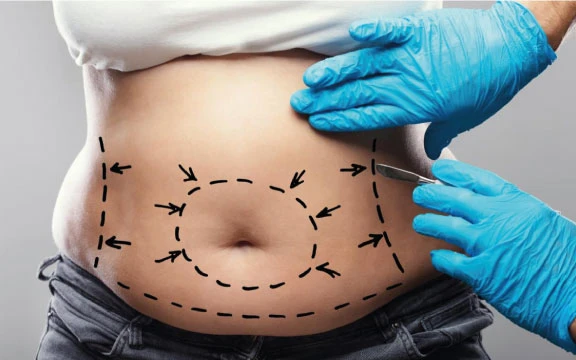 Cirurgia corporal na Bívar Clinic Lisboa — abdominoplastia, lipoaspiração e braquioplastia